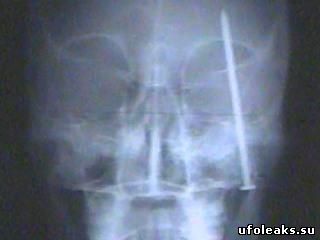 Ренгеновский снимок - гвоздь в черепе