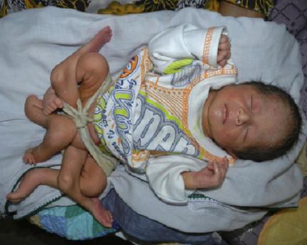 В Пакистане родился ребенок с шестью ногами
